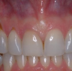Periodontal (gum) disease