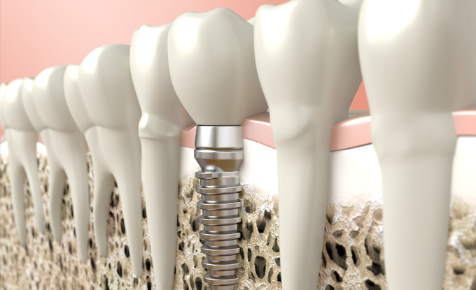 Dr. Borth does Dental implants