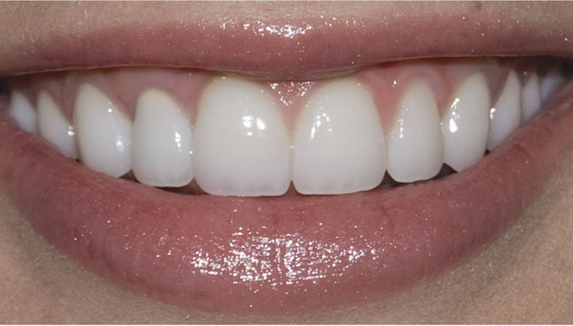 Russell D. Borth DDS in Corpus Christi does Porcelain Veneers