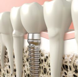 Dr. Borth does Dental implants